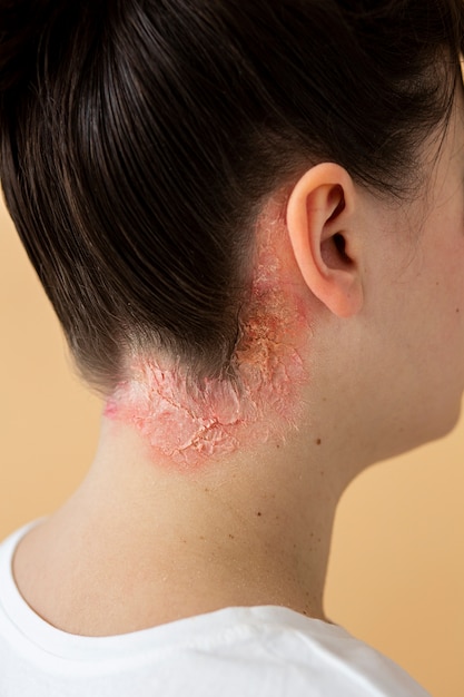 Psoriasis eczema on neck of patient