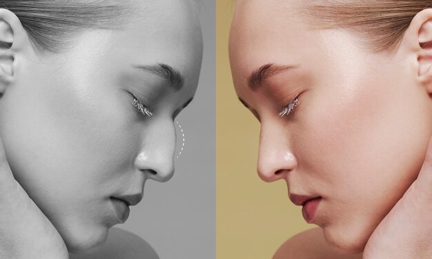 Side view young woman before and after rhinoplasty