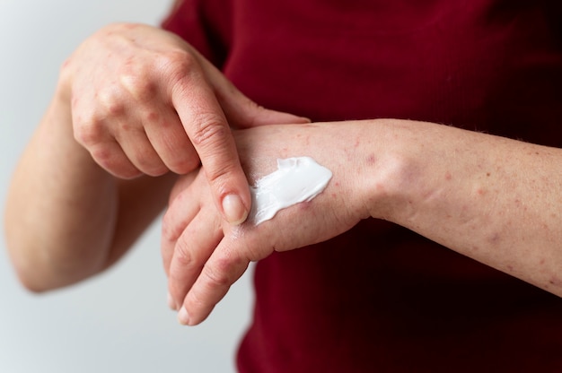 Free Photo skin allergy on a person's arm