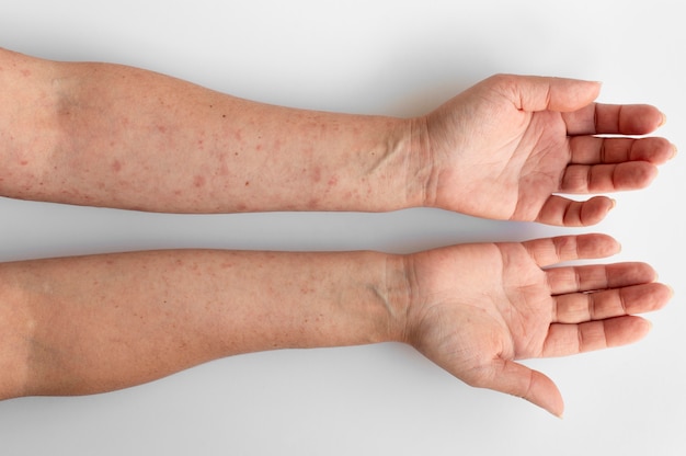 Free photo skin allergy on a person's arms