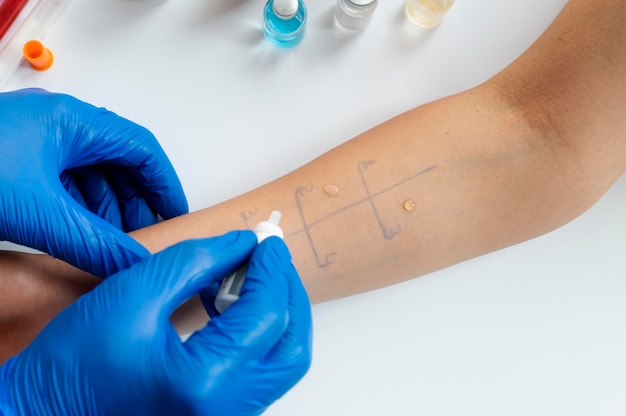 Free Photo skin allergy reaction test on a person's arm