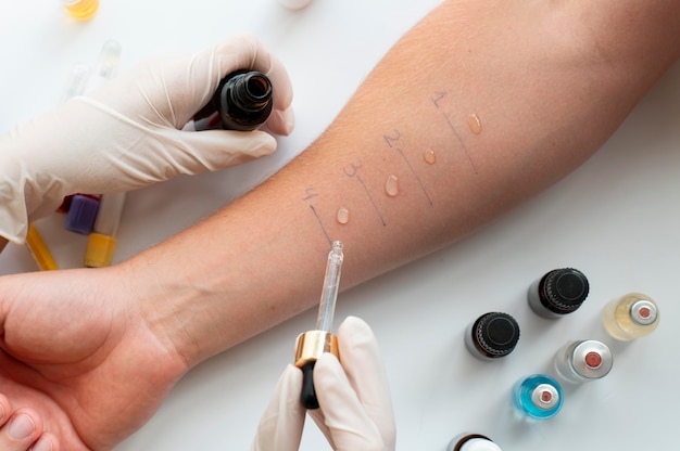 Free Photo skin allergy reaction test on a person's arm