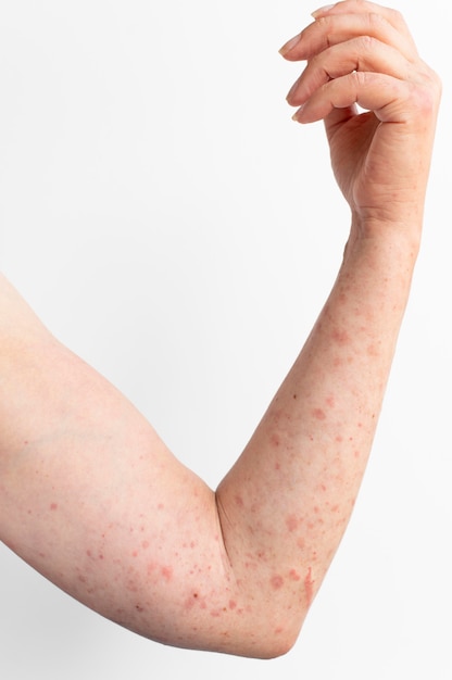 Skin allergy reaction test on a person's arm