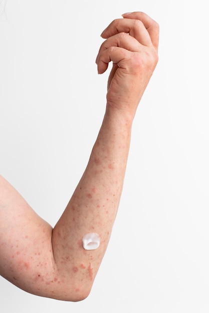 Free Photo skin allergy reaction test on a person's arm