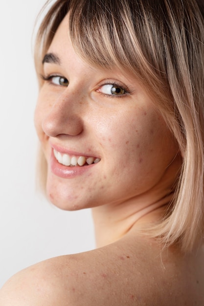 Smiley woman with acne posing close up