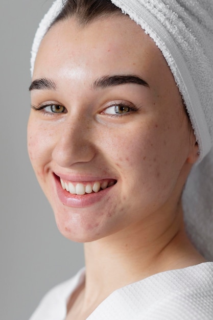 Smiley woman with acne posing