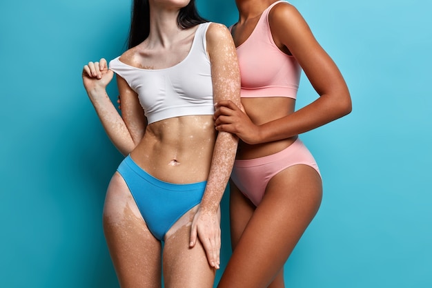 Two women of different skin condition embracing