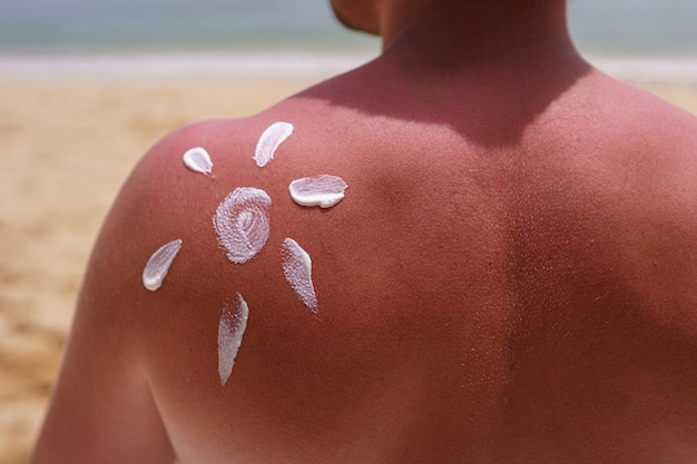 Free photo view of man applying lotion on sunburn skin at the beach