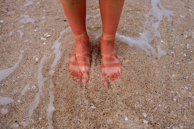 View of a woman's sunburn feet from wearing sandals at the beach