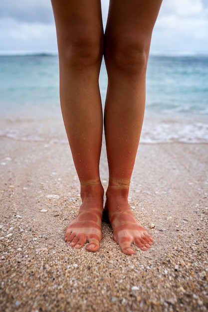 View of a woman's sunburn feet from wearing sandals at the beach