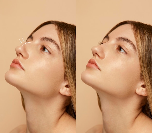 Woman getting ready for nose job surgery