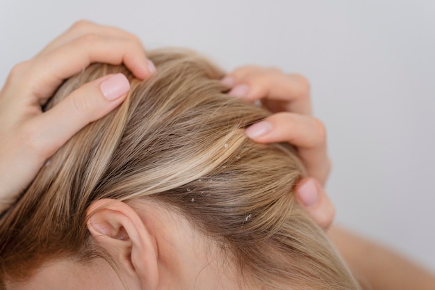 Free Photo woman with dandruff issues close up