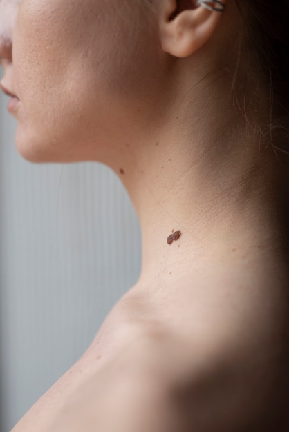 Free Photo woman with melanoma on her skin