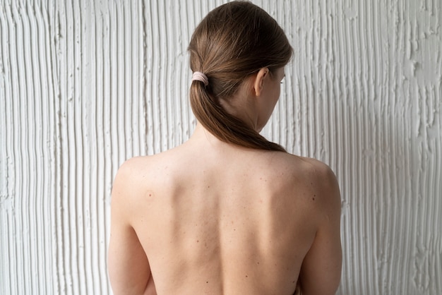 Woman with melanoma on her skin