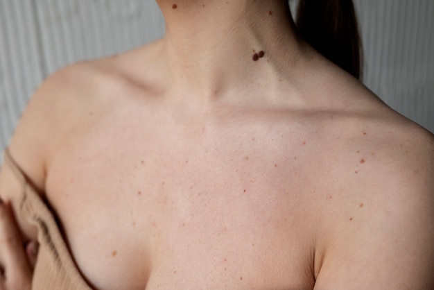 Woman with melanoma on her skin