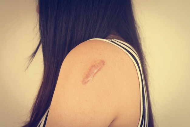 Woman with a scar on her arm