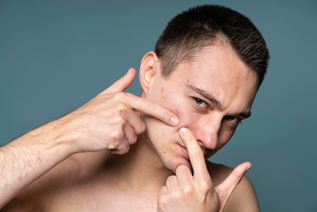 Free Photo young handsome man with acne