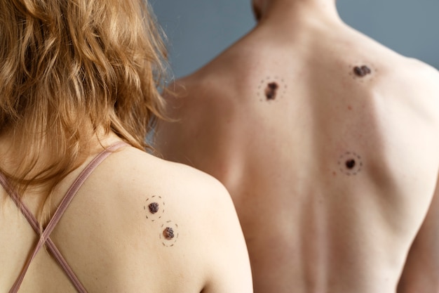 Free Photo young people with melanoma back view