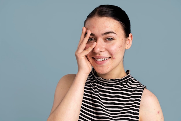 Free Photo young woman being confident with her acne