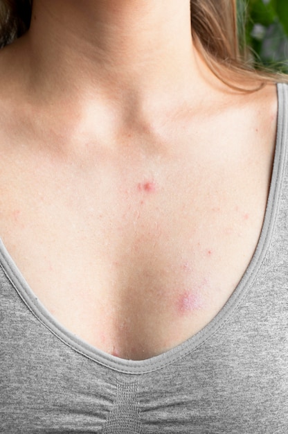 Free photo young woman having skin allergy