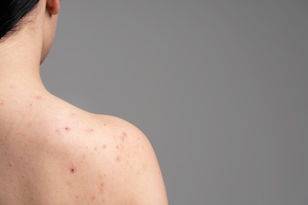 Young woman showing the acne on her shoulders