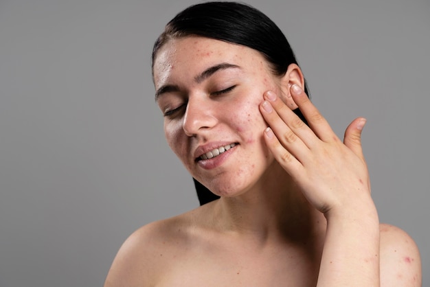 Free photo young woman showing her acne with confidence