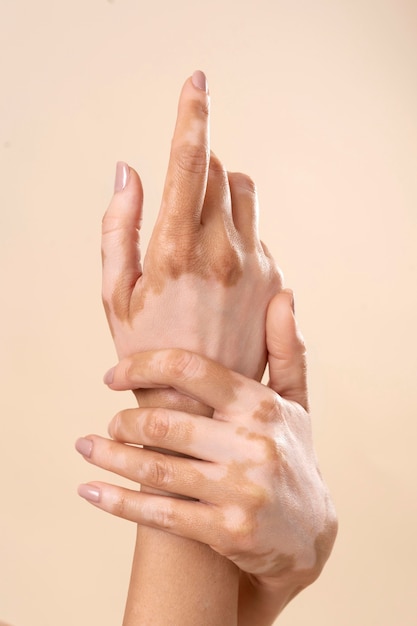 Free photo young woman showing her vitiligo skin parts