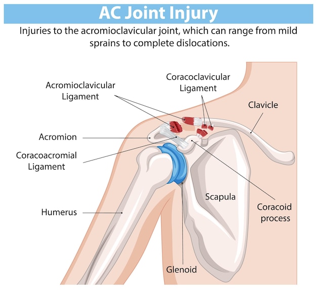 Free Vector ac joint injury diagram