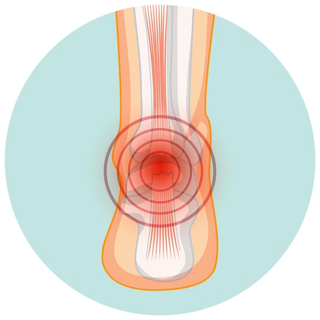 Achilles tendo rupture in circle template