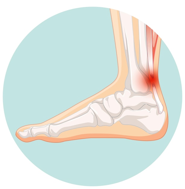 Achilles tendo rupture in circle template