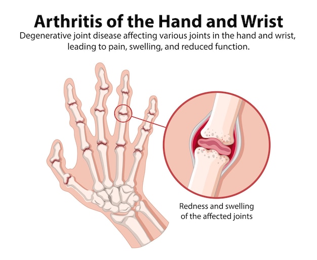 Free vector arthritis of the hand and wrist