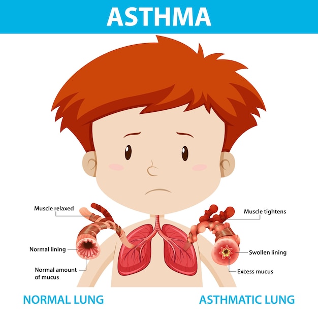 Asthma diagram with normal lung and asthmatic lung