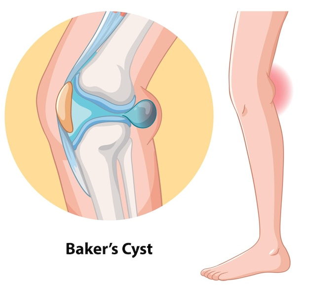 Free Vector bakers cyst in the knee