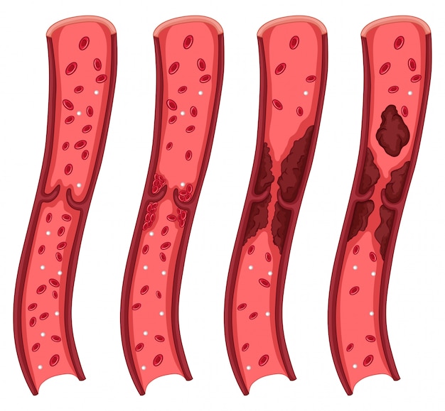 Free vector blood clot diagram on white