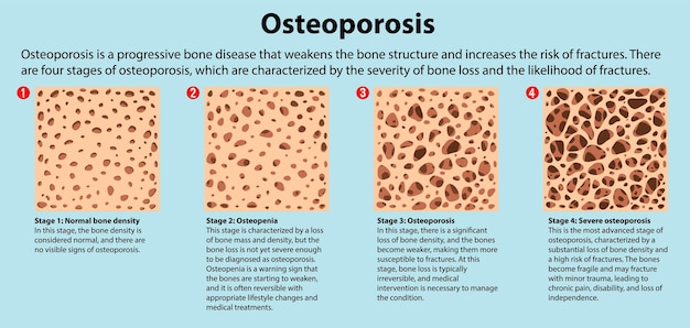 Free vector bone density and osteoporosis vector