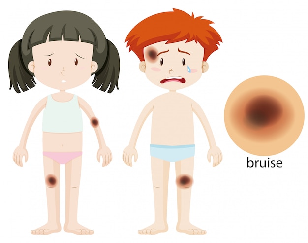 Free Vector boy and girl with bruise