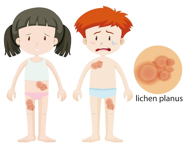 Free Vector boy and girl with lichen planus