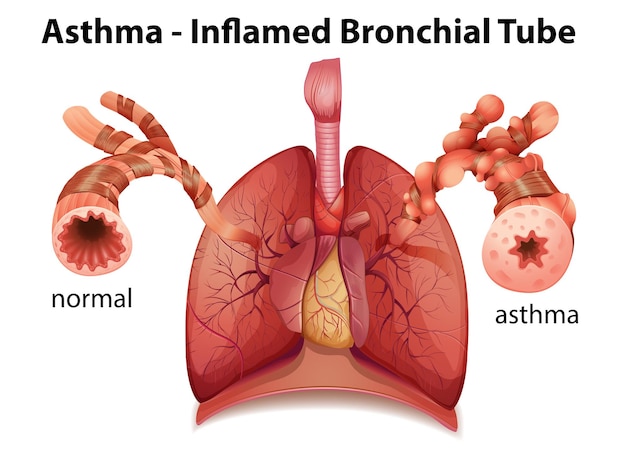 Free Vector bronchial asthma