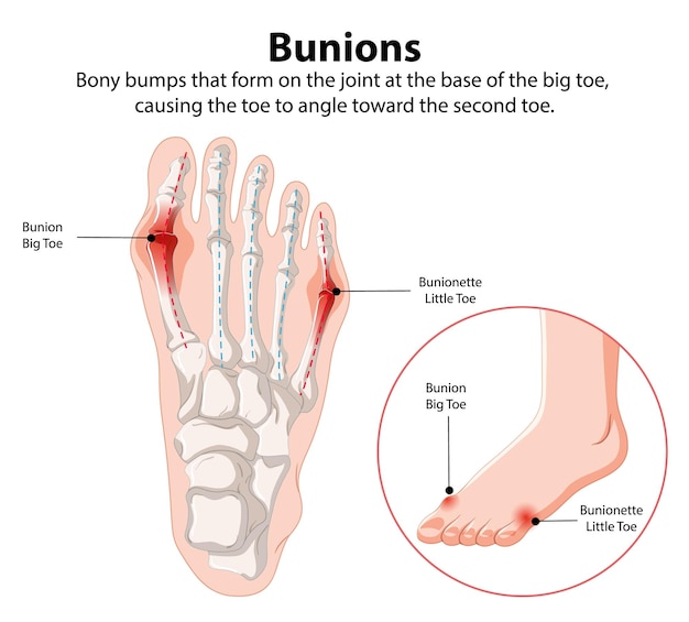 Bunions and Bunionette Illustration