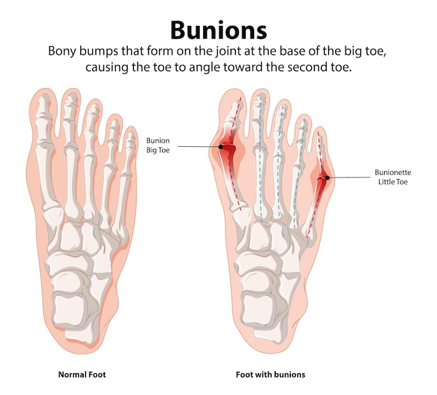 Free Vector bunions normal vs affected foot