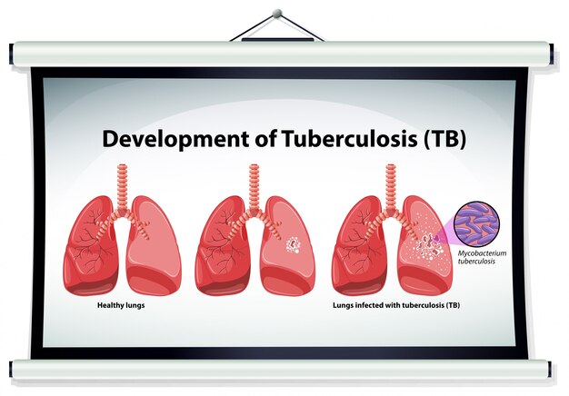 Chart showing development of Tuberculosis