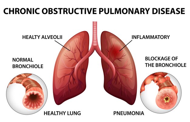 Chronic obstructive pulmonary disease