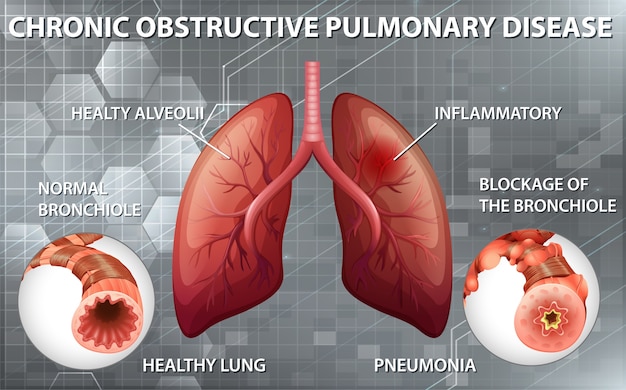 Chronic obstructive pulmonary disease