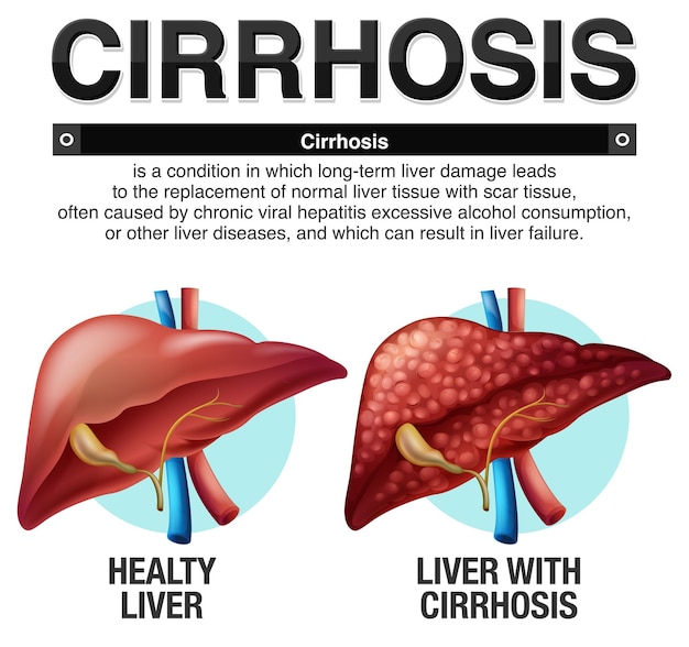 Cirrhosis of the Liver Infographic