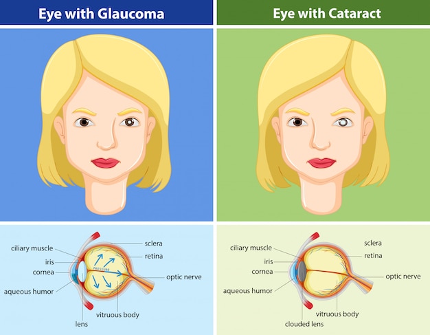 Free Vector comparison chart of eyes with and without glaucoma