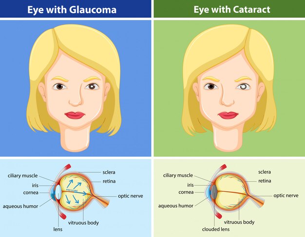 Comparison chart of eyes with and without glaucoma