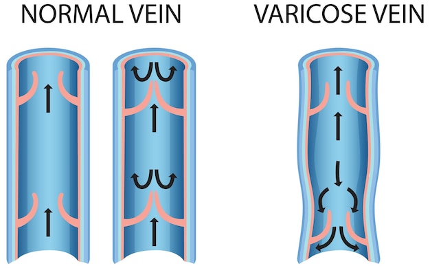 Free Vector a comparison of normal vein with varicose vein