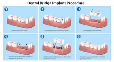 Free vector dental bridge implant procedure