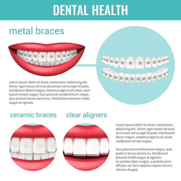 Free Vector dental health infographics set with metal and ceramic braces realistic vector illustration