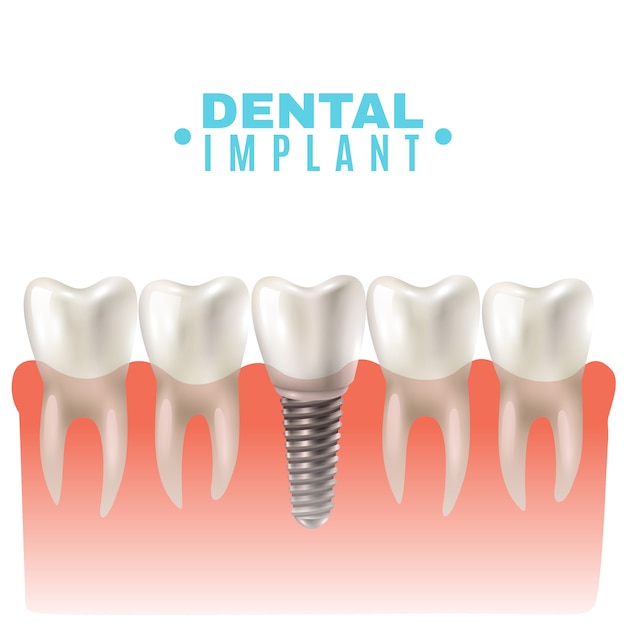 Dental Implant Model Side View Poster 